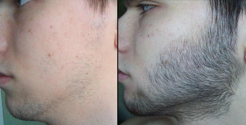 Antes y después con MÓKAVICH® Gel Barba